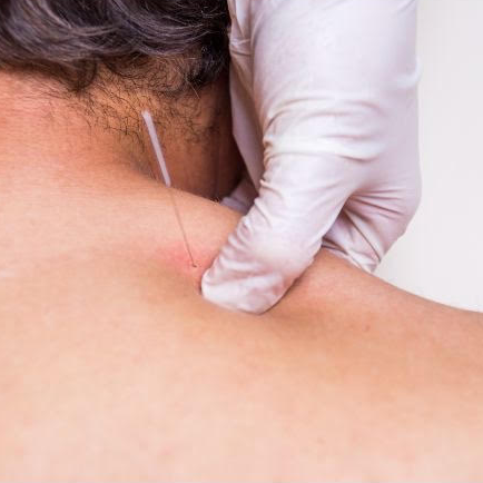 Trigger Point Dry Needling
